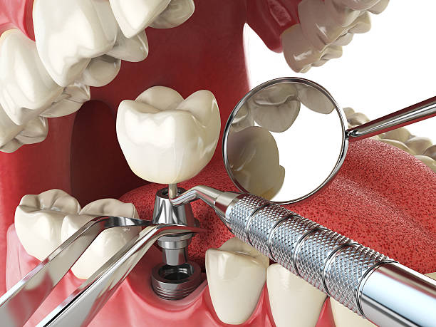 Best Emergency Root Canal Treatment in Mannington, WV
